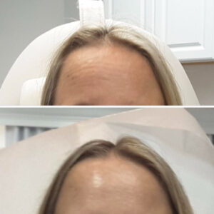 100 units of Dysport or Daxxify and 2 syringes of Filler